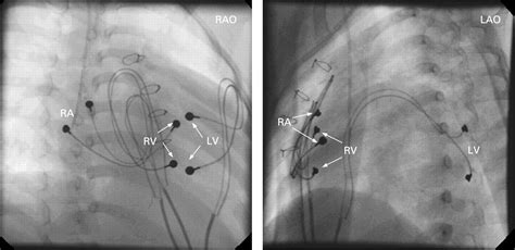 lv epicardial lead placement|epicardial Lv lead placement.